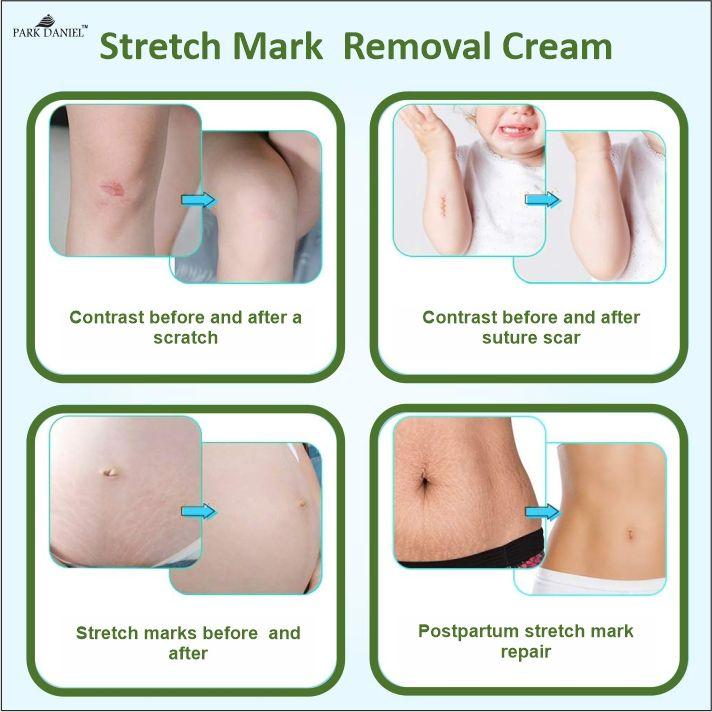 Park Daniel Stretch Marks Removal During Pregancy | Weight Loss Skin Toining (100 grams)