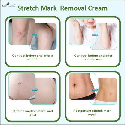 Park Daniel Stretch Marks Removal During Pregancy | Weight Loss Skin Toining (100 grams)